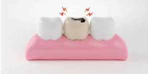 long-lasting dental implants